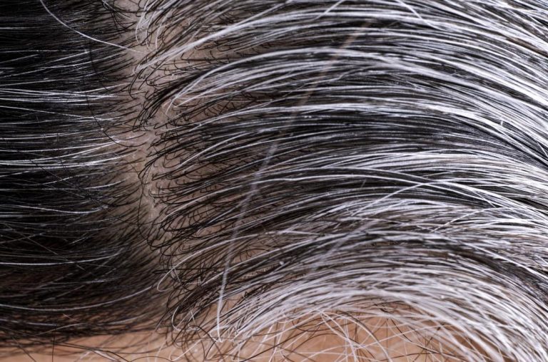 white-and-gray-hairs-growing-on-person-s-head